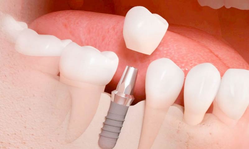 Implantes Dentales Vitacura