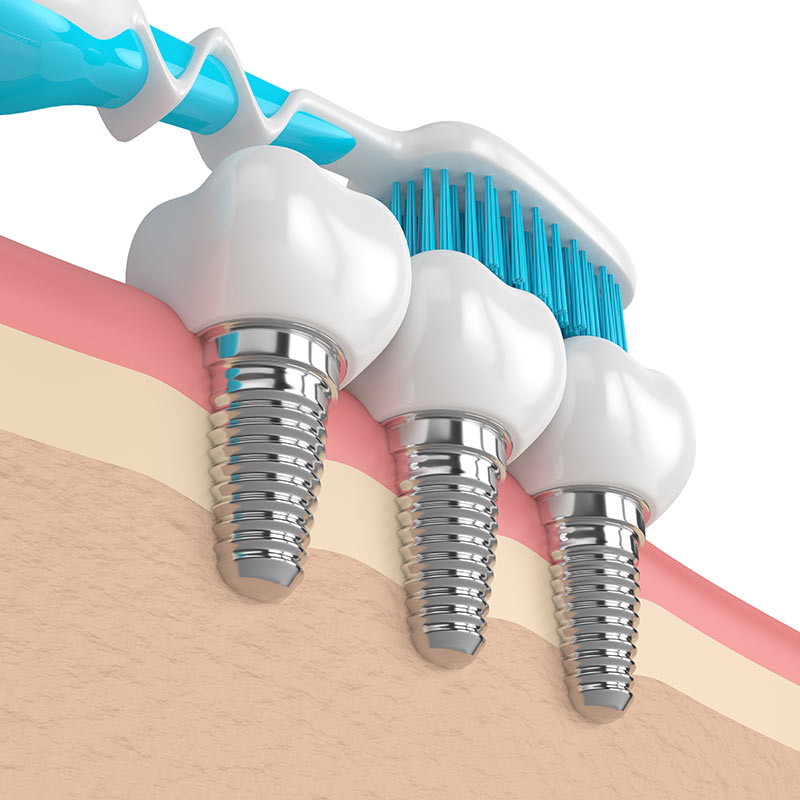 Implantes Dentales  Ñuñoa