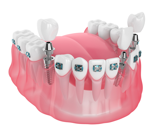   Implantes Dentales  Providencia 