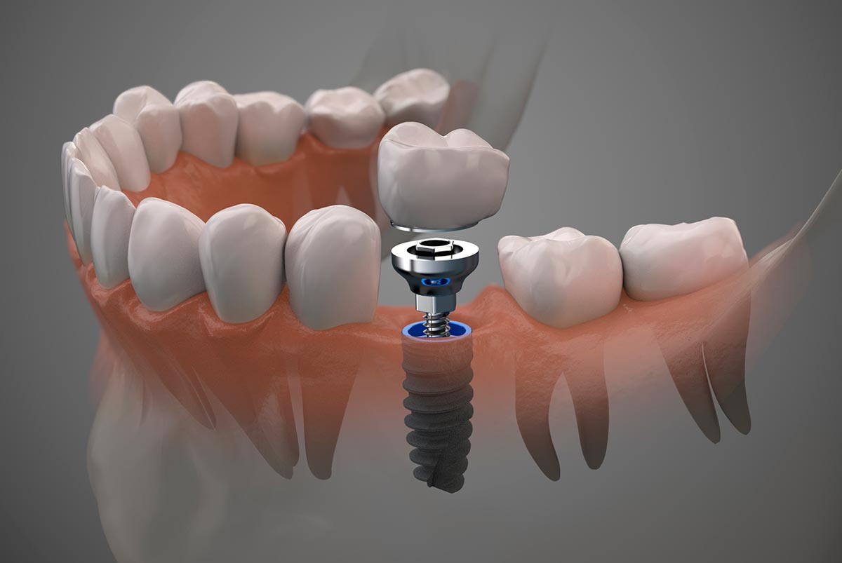 Implantes Dentales  La Dehesa