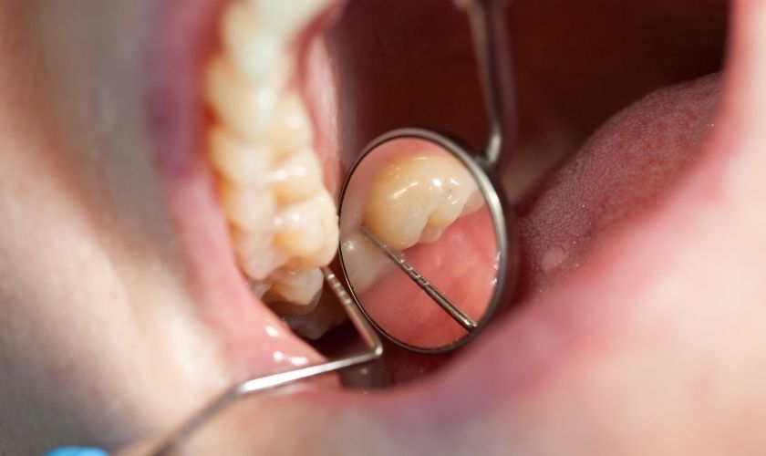 Mantención periodontal Las Condes