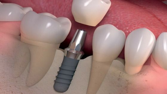 Implantes Dentales Cerillo
