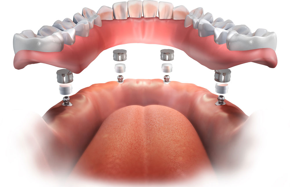 Implantes Dentales Pudahuel